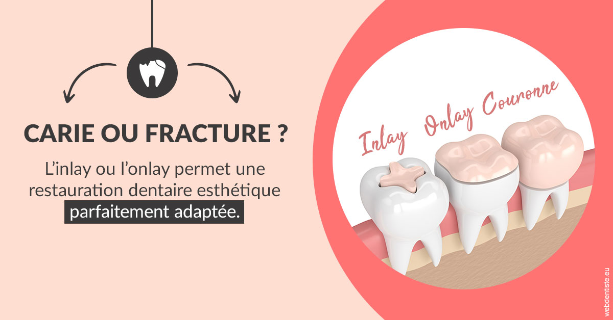 https://dr-luc-sebaoun-stephane.chirurgiens-dentistes.fr/T2 2023 - Carie ou fracture 2