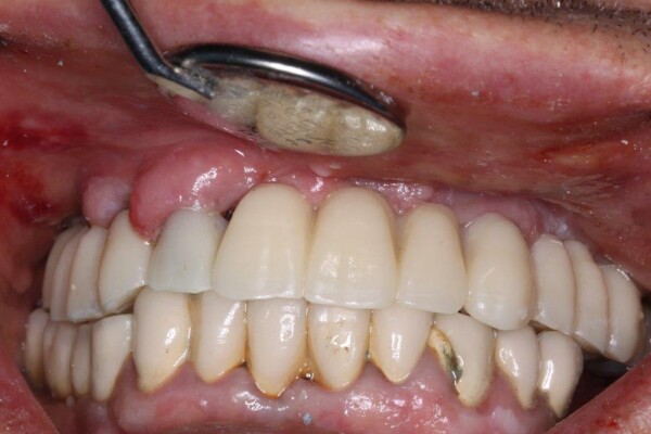 Cas 2 : Extraction de 8 dents pose de 6 implants et d’un bridge provisoire de 14 dents en 1 seule séance grâce aux guides à étages.