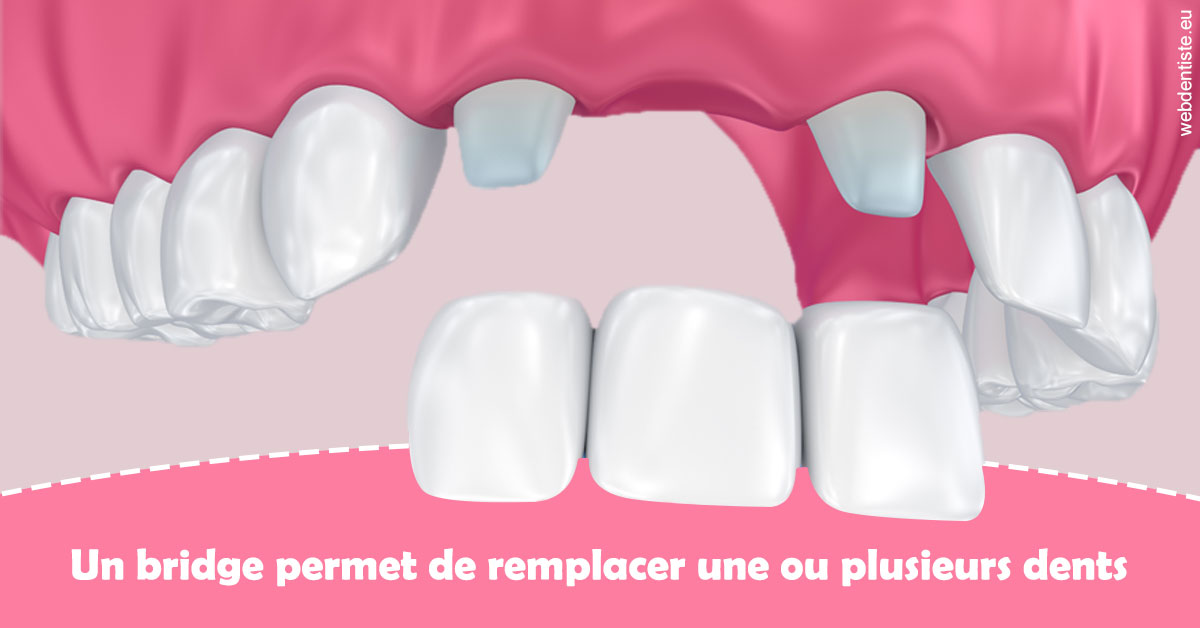 https://dr-luc-sebaoun-stephane.chirurgiens-dentistes.fr/Bridge remplacer dents 2