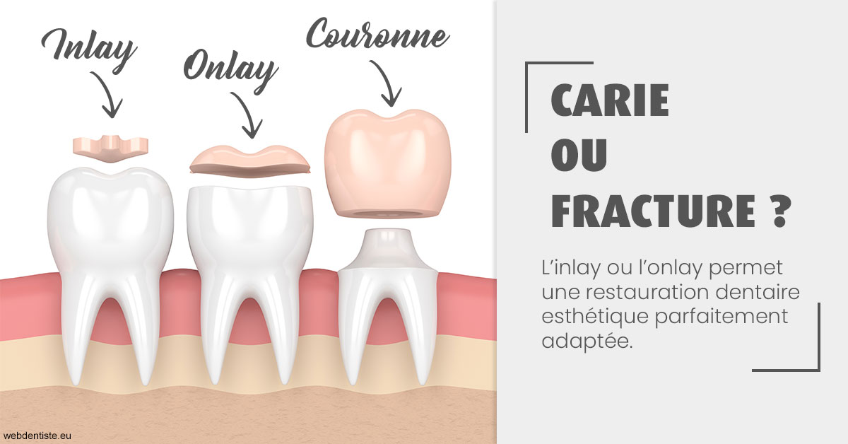 https://dr-luc-sebaoun-stephane.chirurgiens-dentistes.fr/T2 2023 - Carie ou fracture 1