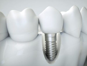 Pose de 2 implants dentaires par le Dr Luc-Sebaoun à Paris