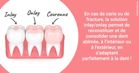 https://dr-luc-sebaoun-stephane.chirurgiens-dentistes.fr/L'INLAY ou l'ONLAY 2