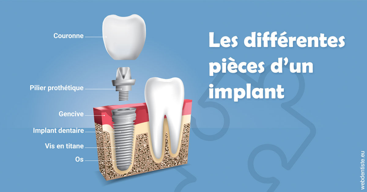 https://dr-luc-sebaoun-stephane.chirurgiens-dentistes.fr/Les différentes pièces d’un implant 1